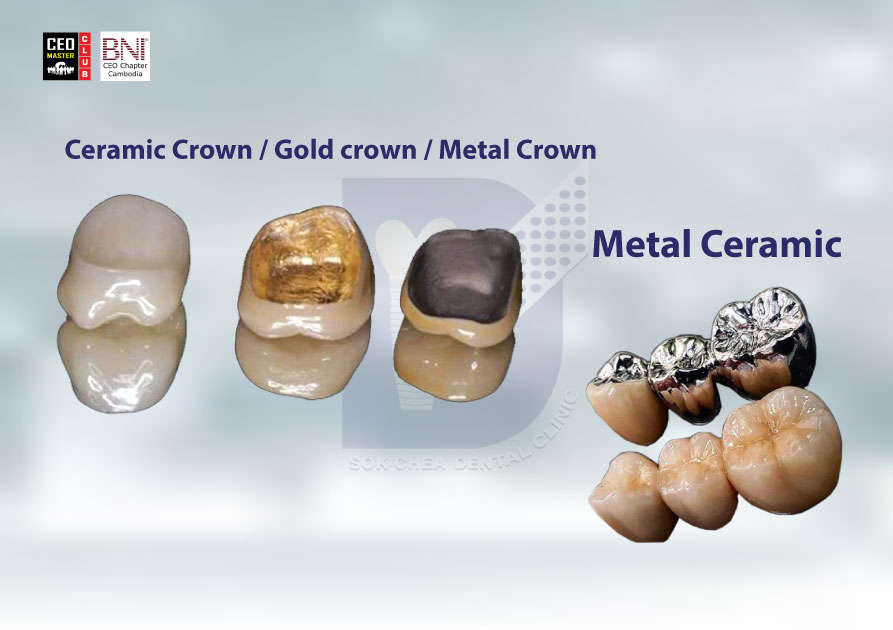 A5(Ceramic-crown-gold-crown-Metal-crown---metal-ceramic)