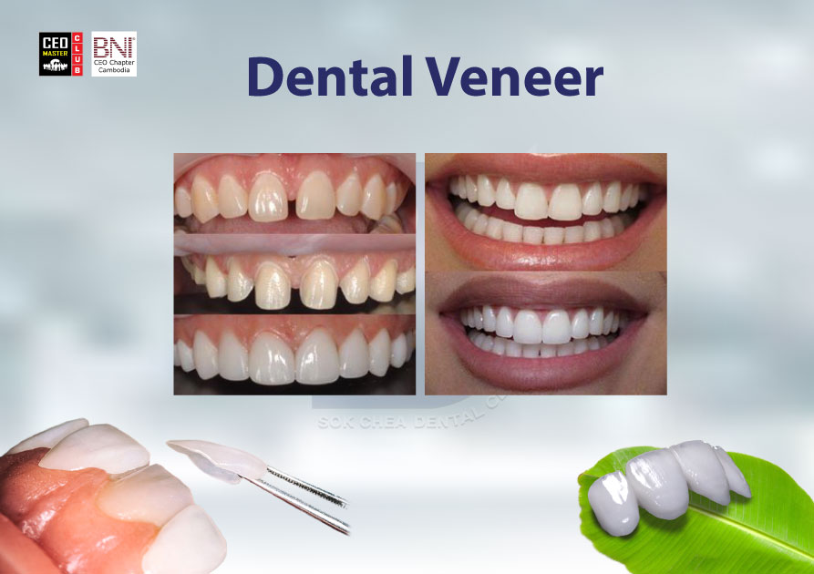A5(Dental-Veneer)