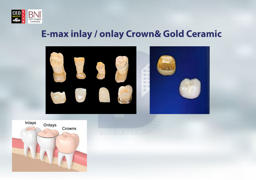 A5(E-Max-inlay---onlay-crown&-gold-ceramic)