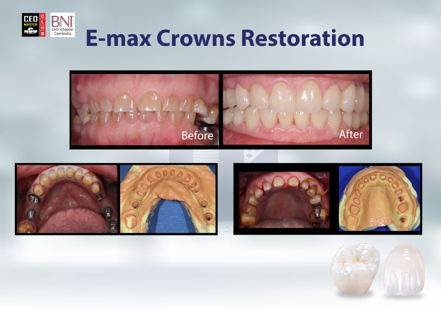 A5(Emax-crown)