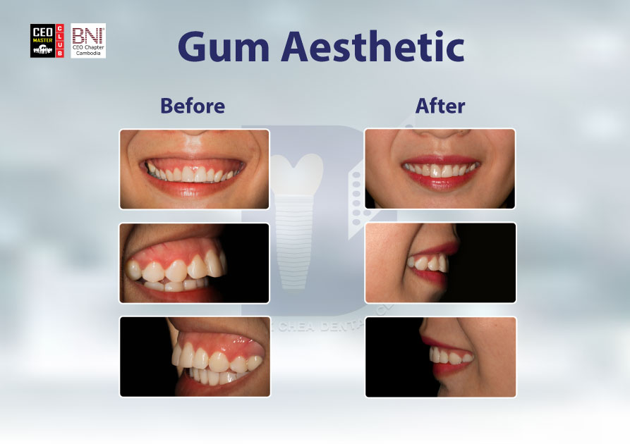 A5(Gum-Asethetic)