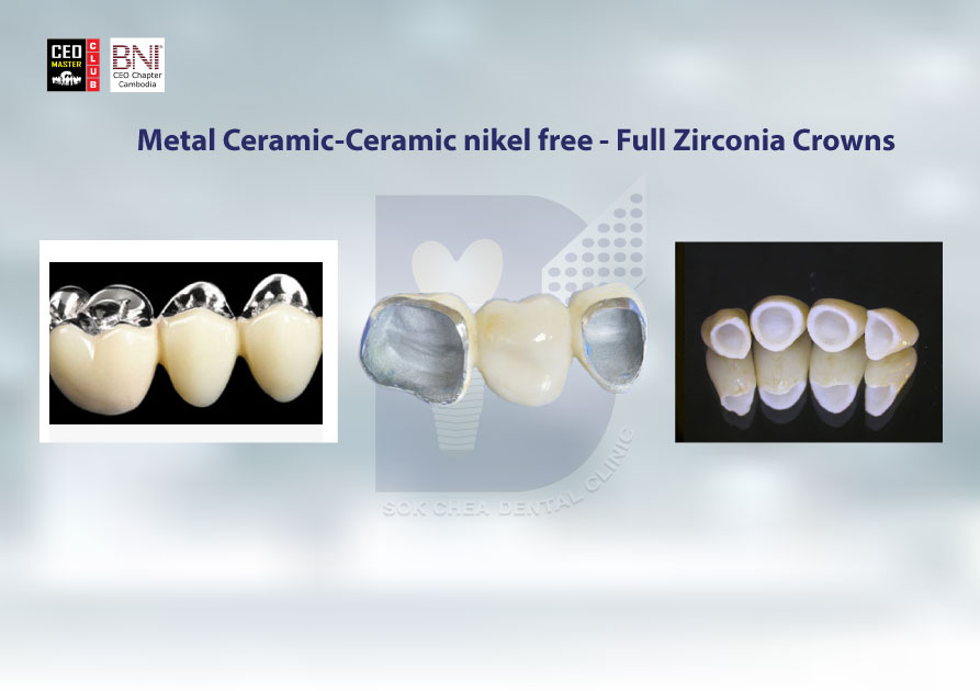 A5(Metal-Ceramic-Metal-free-crown---Metal-free-porcelain)