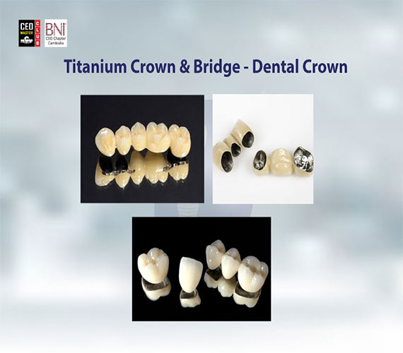 A5(Titanium-Crown-&-Bridge---Dental-Crown)