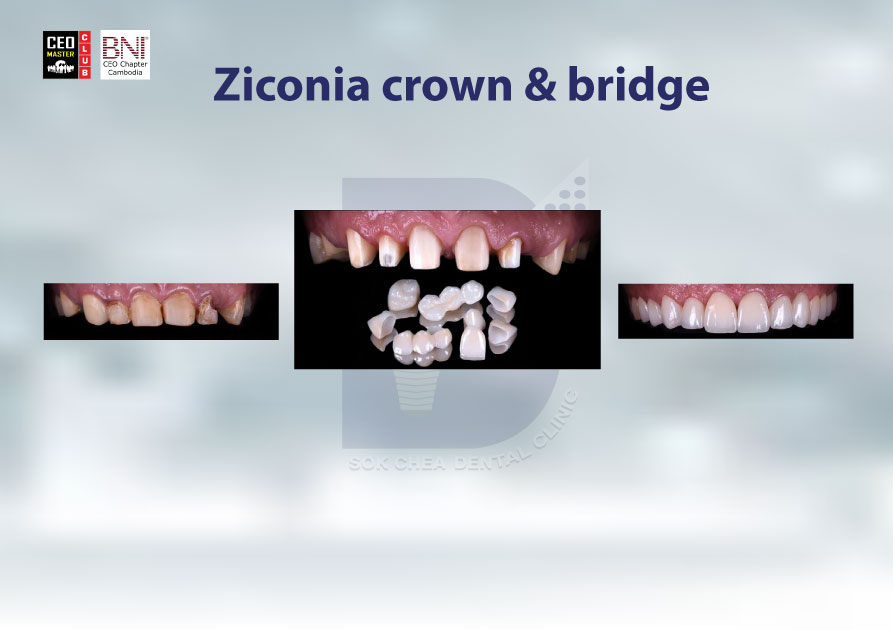 A5Ziconia-crown-&-bridge