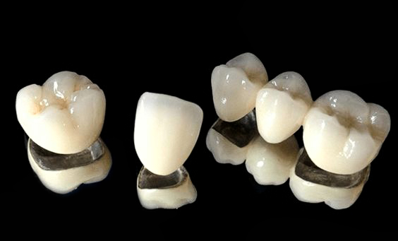 Titanium crown & bridge