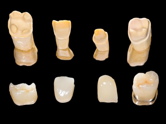 emax-inlay-onlay-crowns