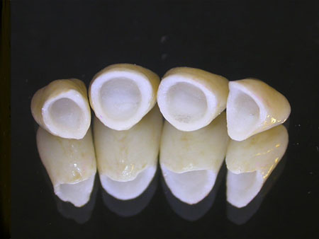 metal-free-porcelain